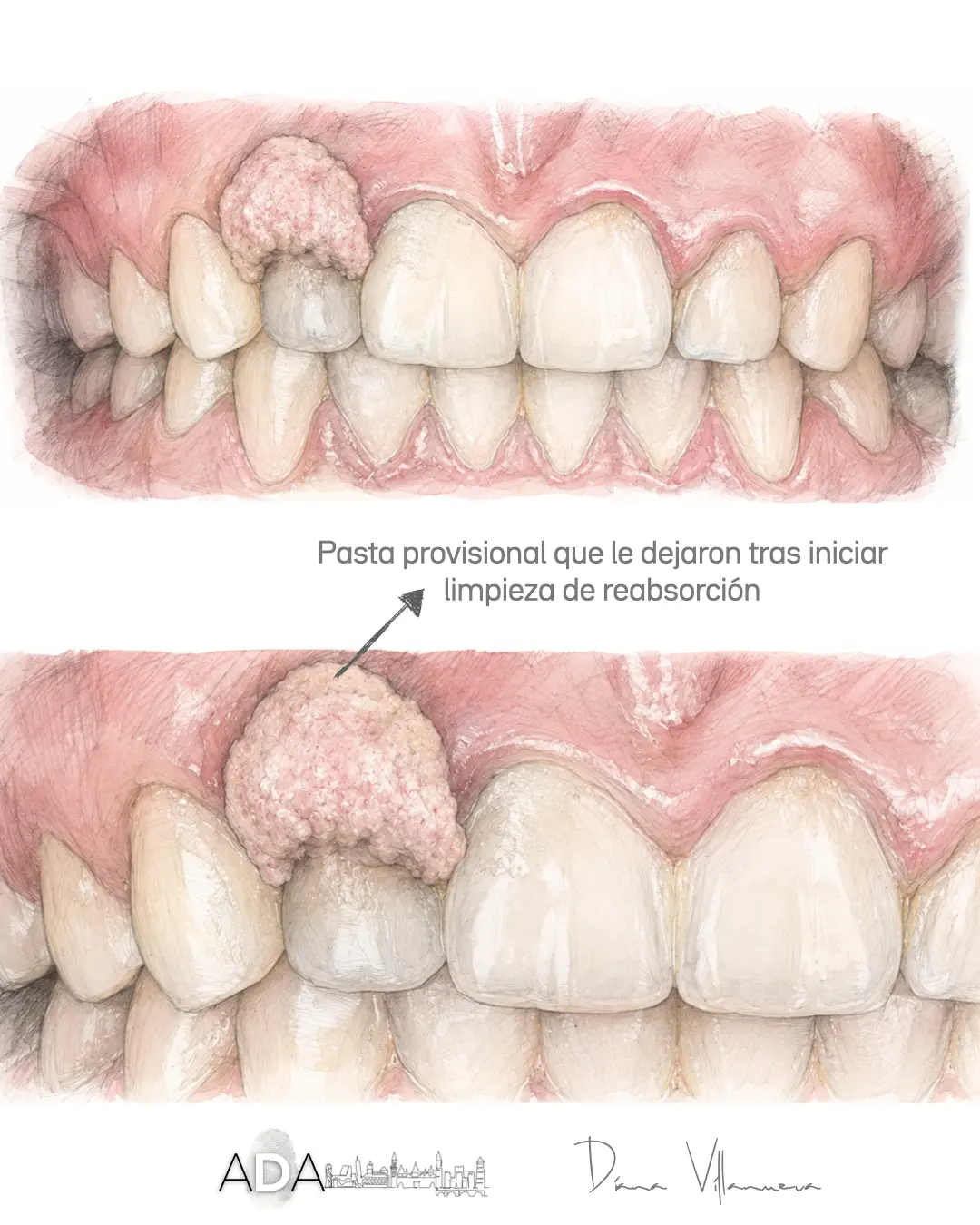 Reabsorción cervical invasiva: 3 claves imprescindibles para conservar el diente