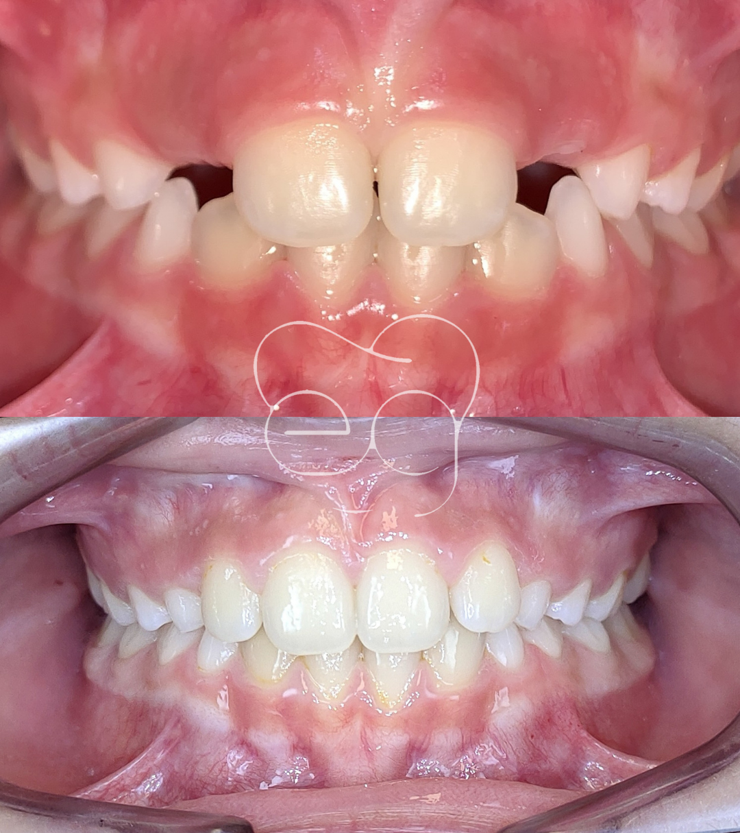 Optimización funcional y desarrollo craneofacial en paciente pediátrico: un abordaje RMR