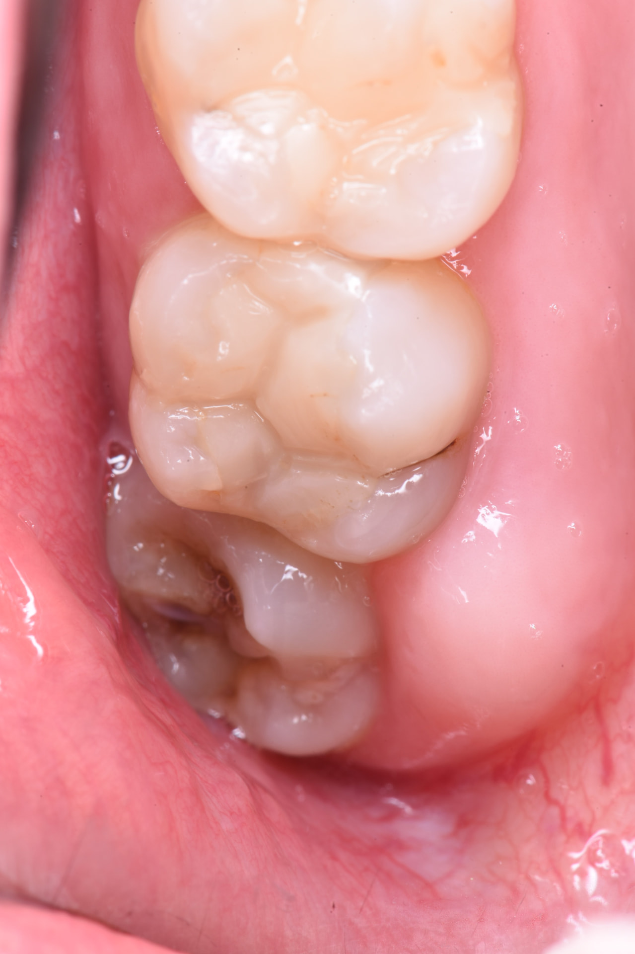 Autotransplante dental: 1.8 a la posición de 1.7