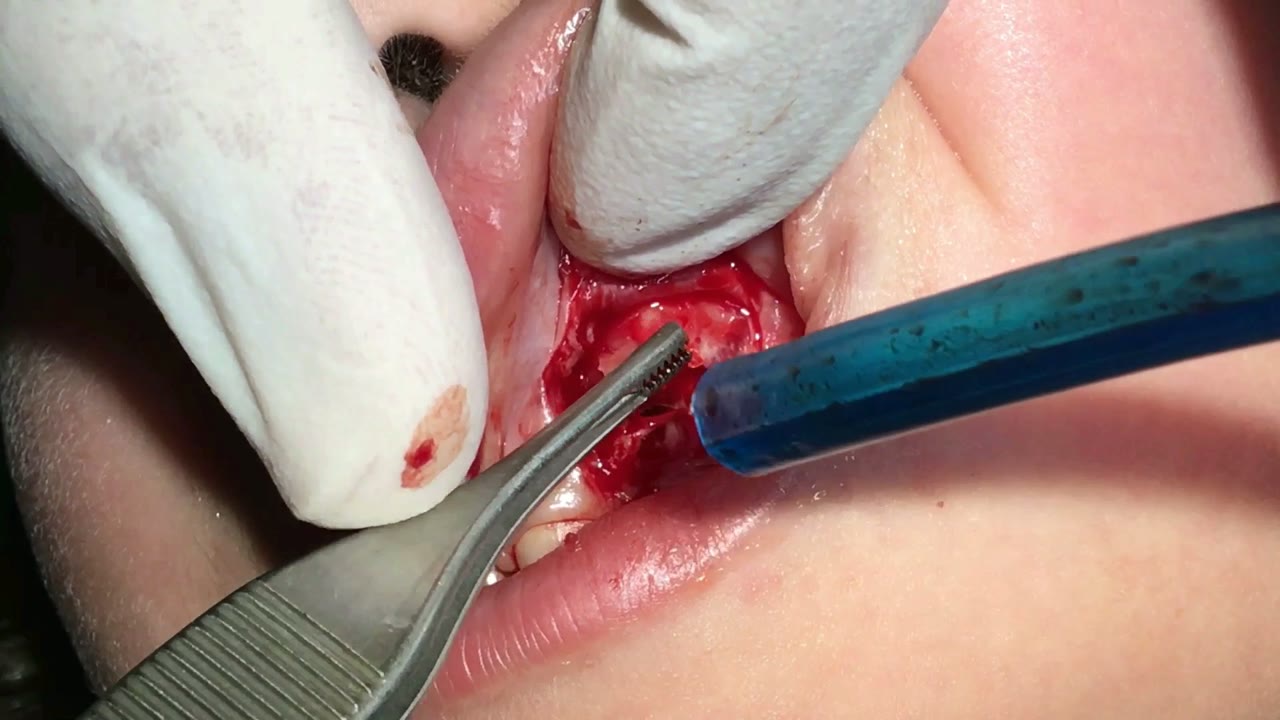 Odontoma maxilar en paciente de 6 años