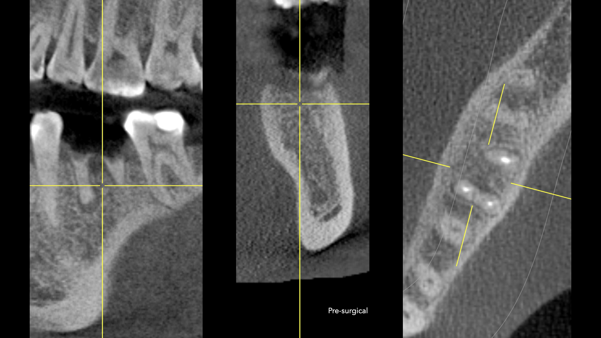 Implante inmediato postextracción en el 3.6 con oseodensificación: conservación íntegra del septo interradicular