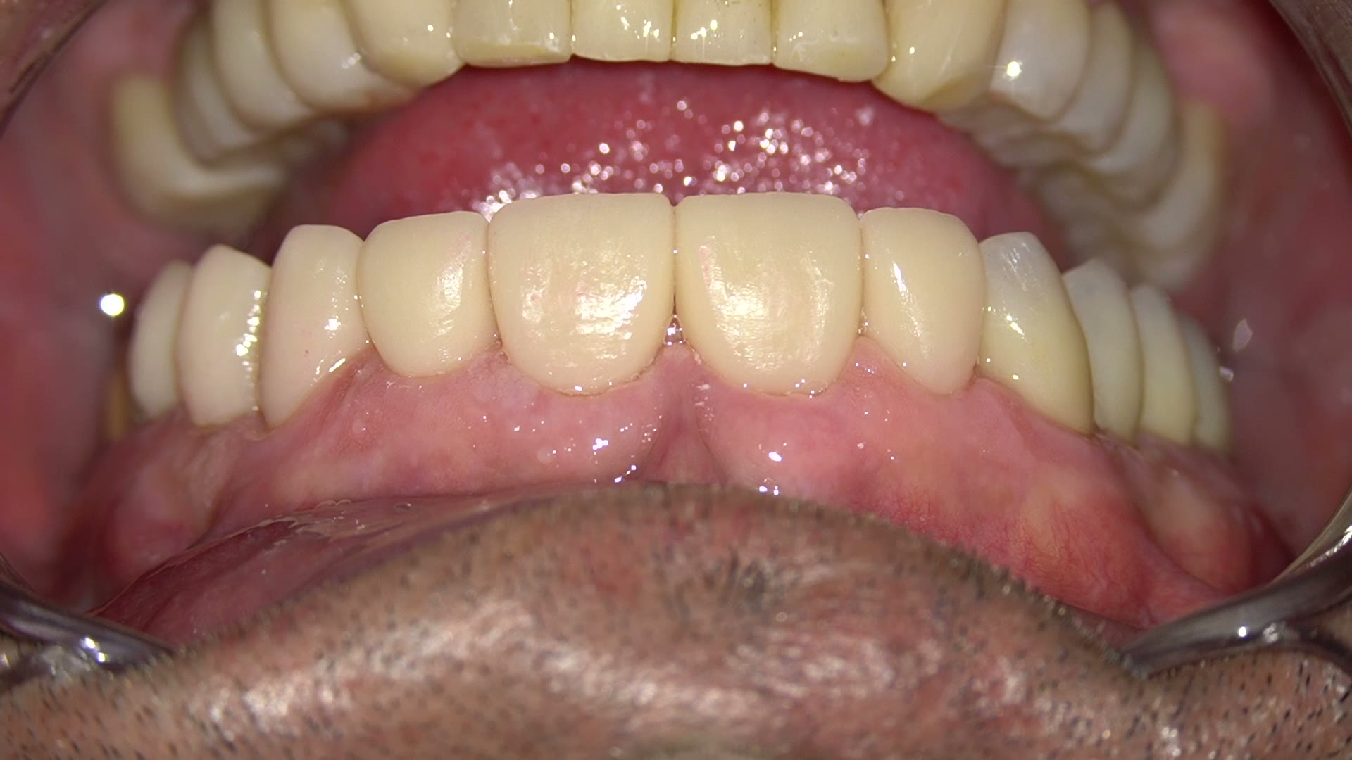 Nivelación de márgenes gingivales mediante gingivectomía y modificación del provisional
