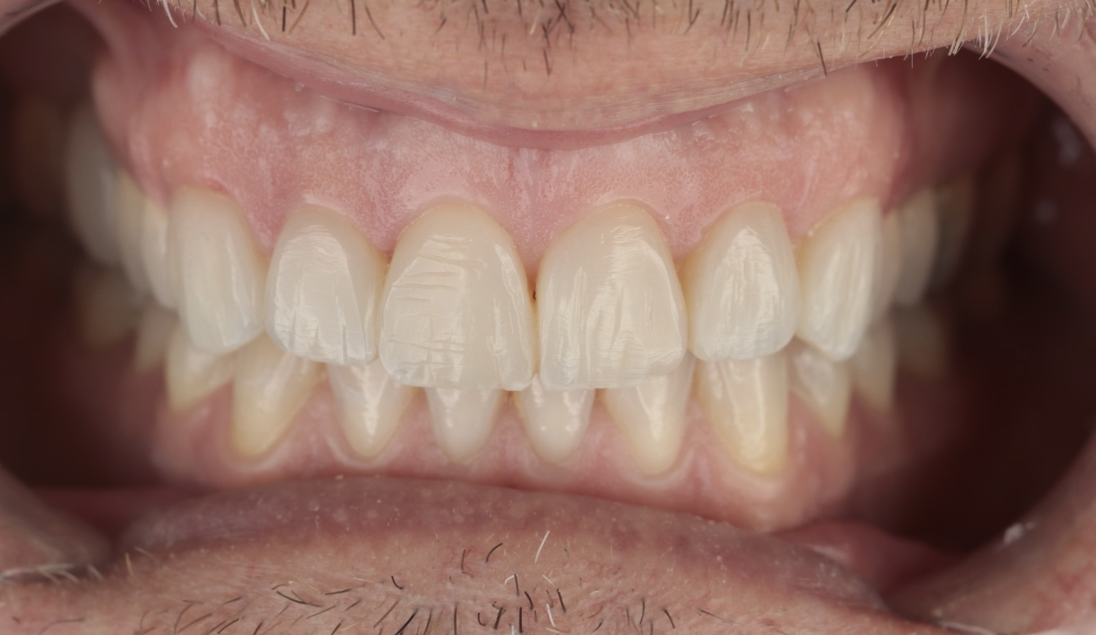 Protocolo de estética anterior con seis composites directos: blanqueamiento combinado, estratificación y férula Michigan