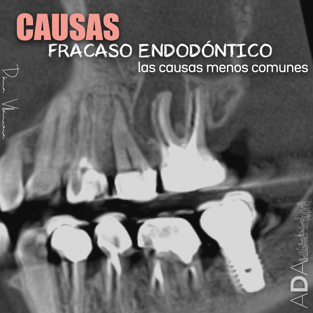 Fracaso endodóntico del 1.6: cuando la causa está fuera del conducto