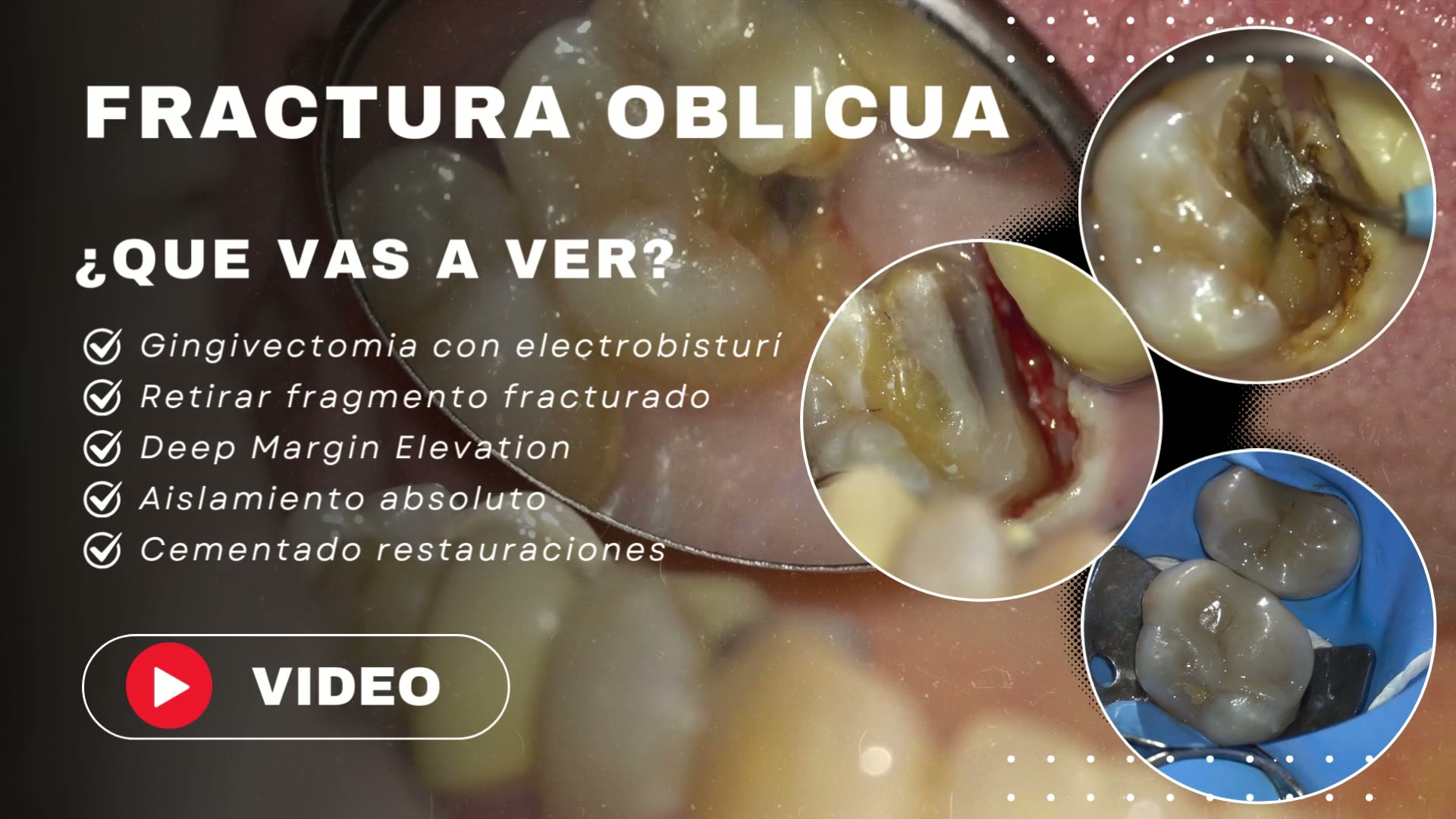 Restauración de una fractura vertical subgingival mediante elevación de margen
