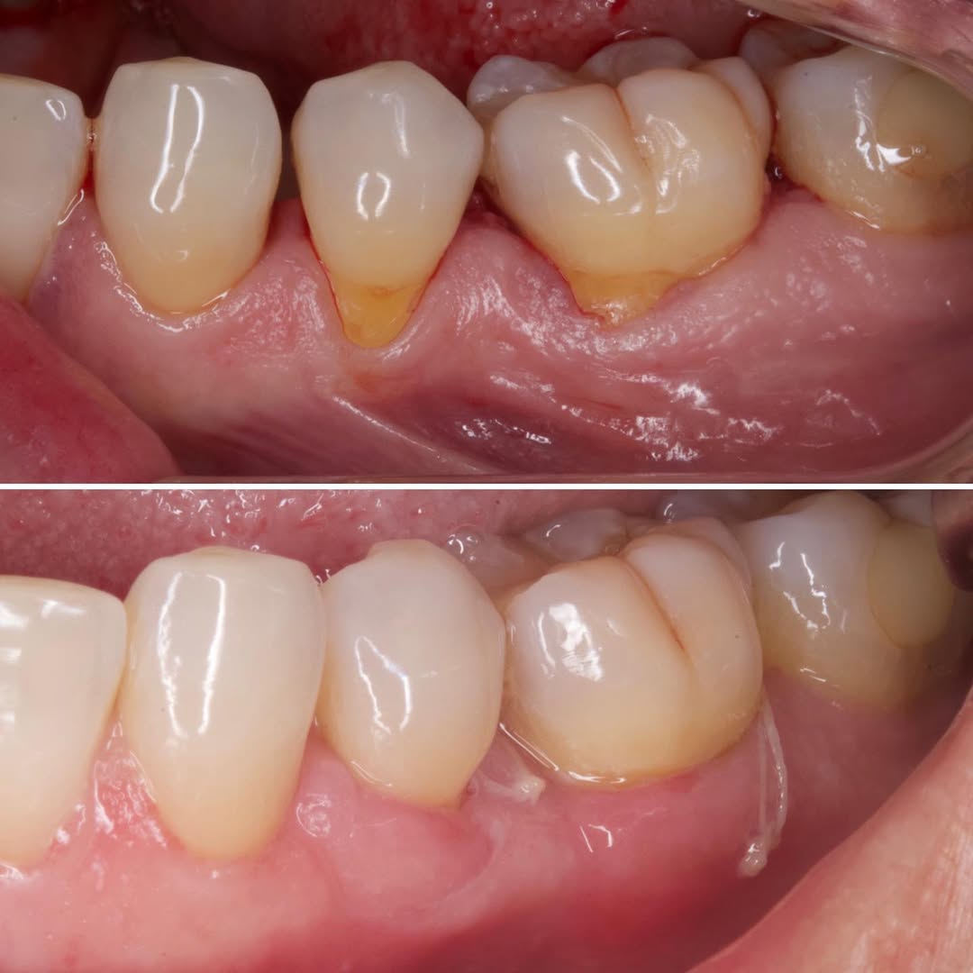 Manejo de recesiones múltiples mandibulares mediante colgajo de avance coronal y abordaje combinado
