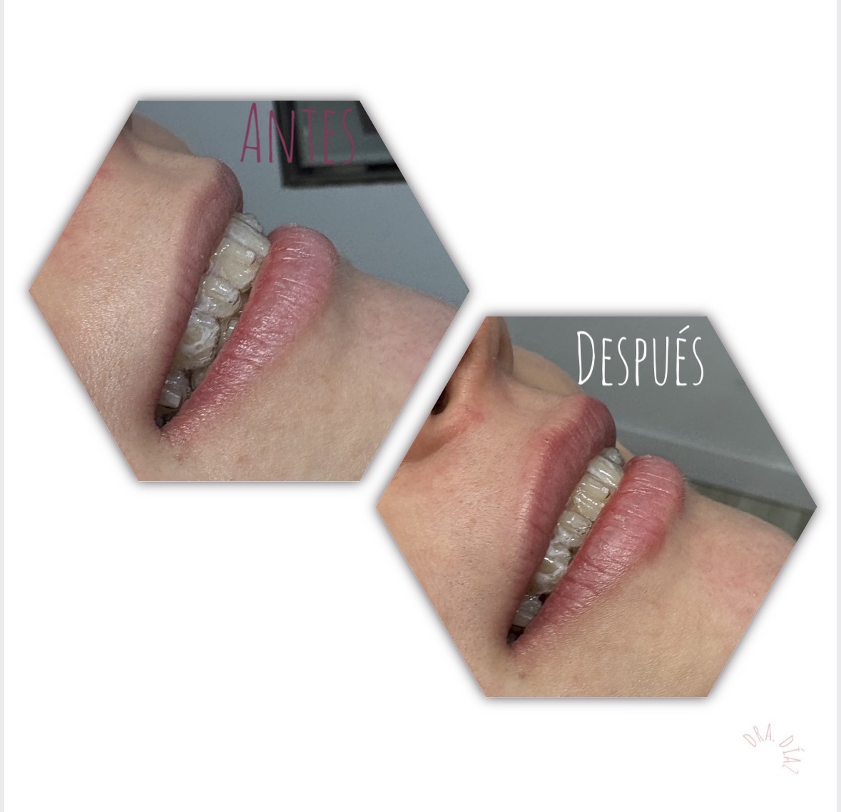 Hidratación labial con ácido hialurónico: corrección de asimetría del labio superior