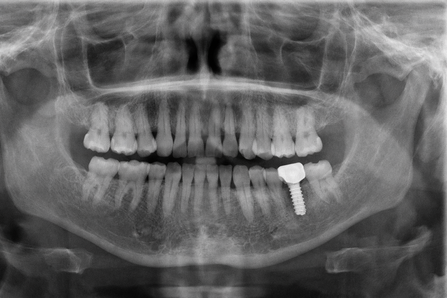 Mucositis periimplantaria por déficit de higiene interproximal