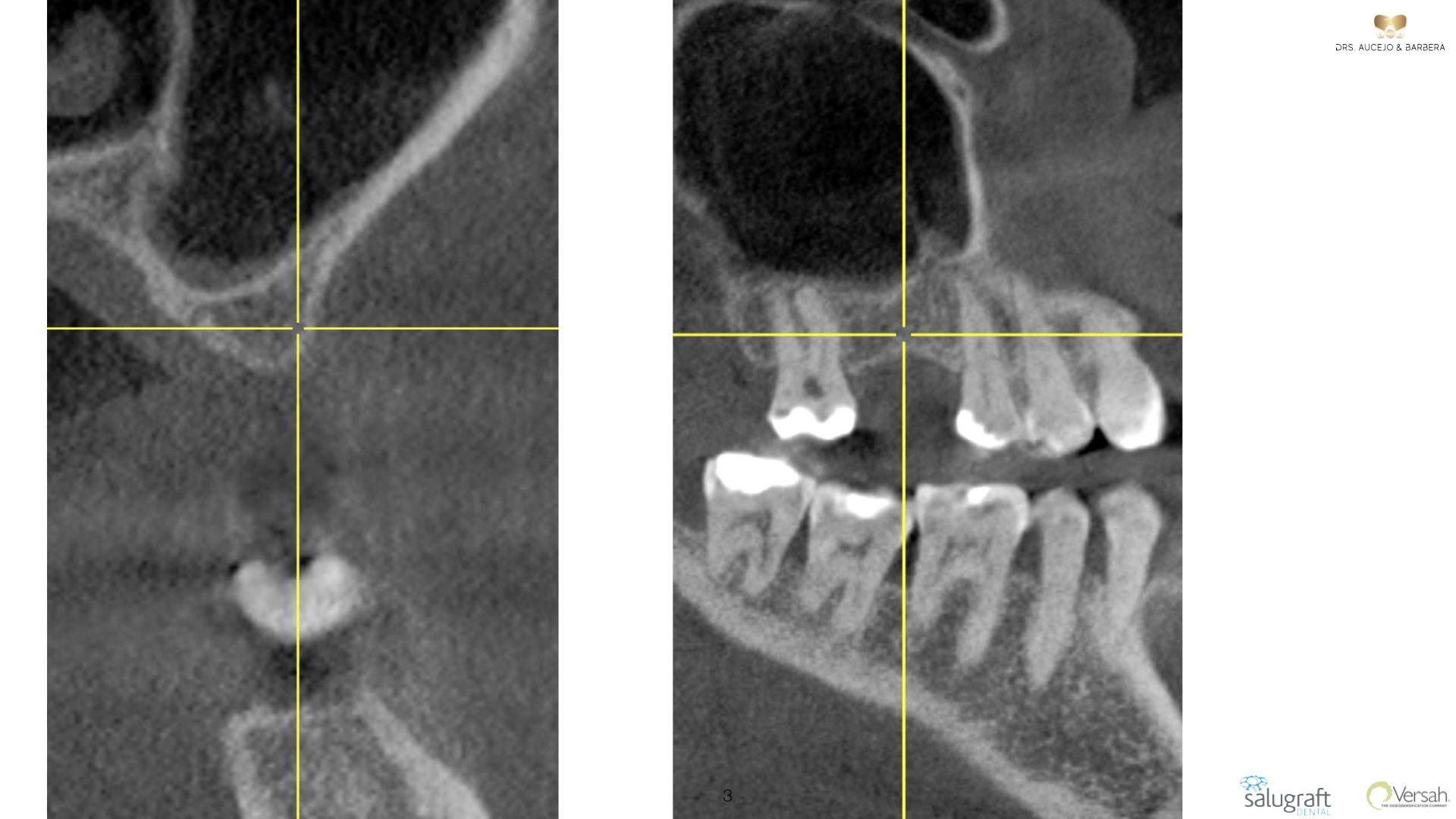 Elevación de seno transcrestal con oseodensificación: implante en maxilar posterior con altura ósea limitada