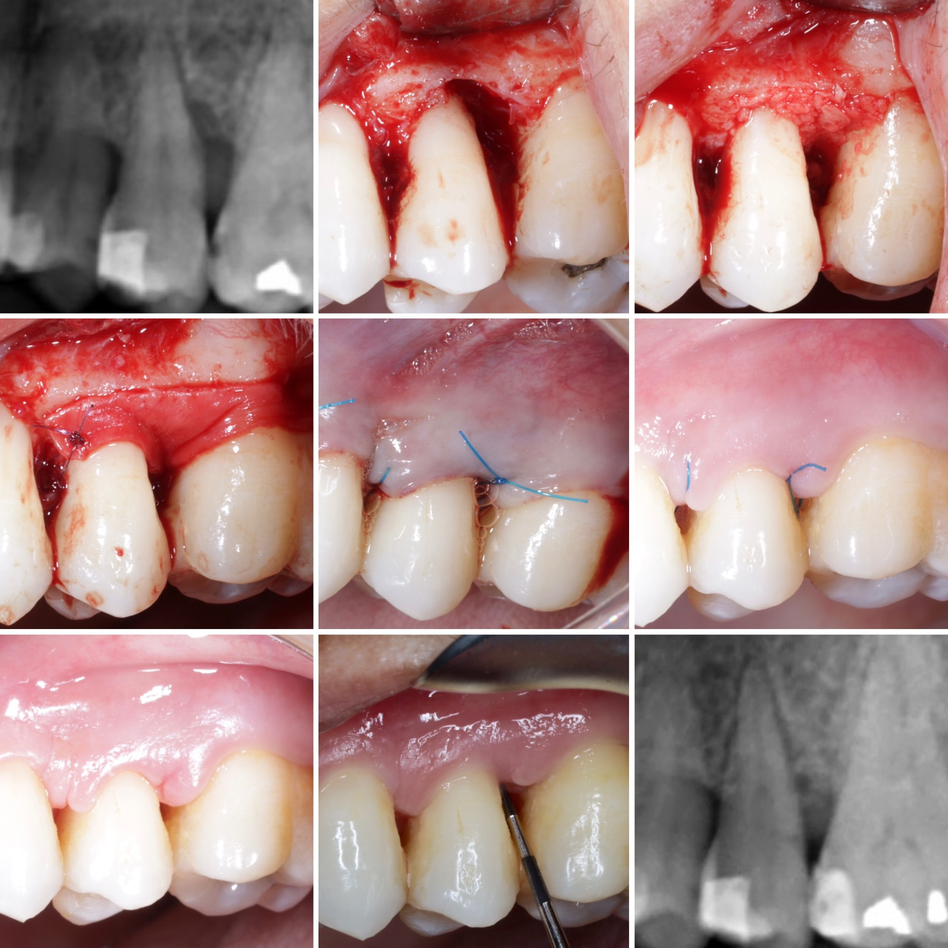 Defecto periodontal en el 2.5: regeneración tisular guiada con bolsa de 9 mm y supuración activa