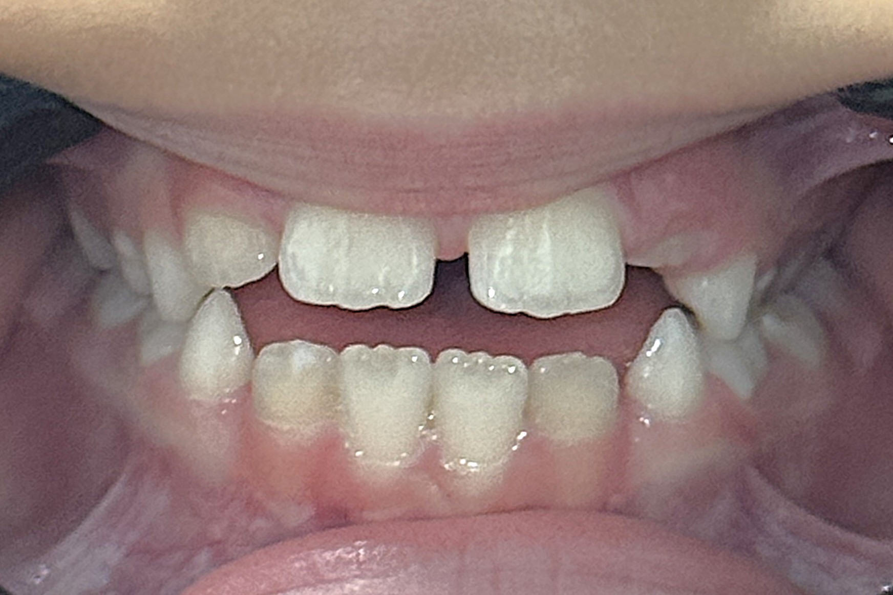Cierre de mordida abierta con Invisalign First: descruzar, cerrar y guiar el recambio en una niña de 7 años