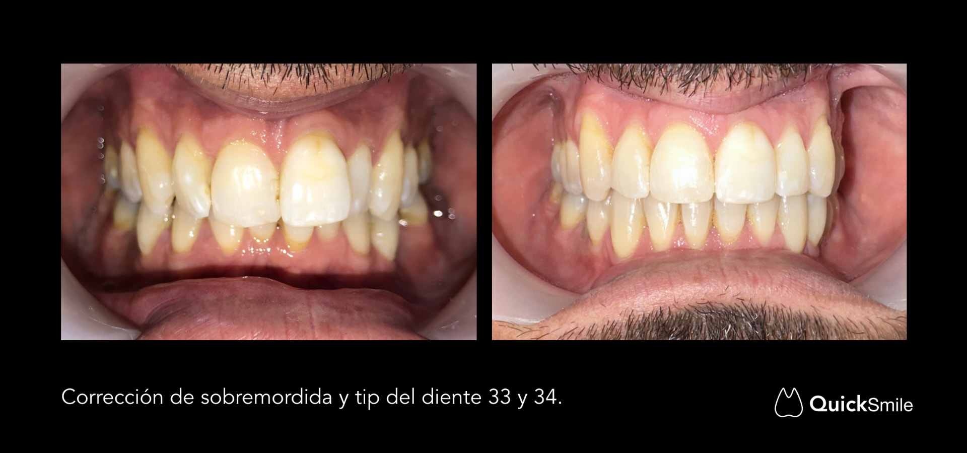 Corrección de sobremordida y tip del 33 y 34 con apiñamiento anterior superior