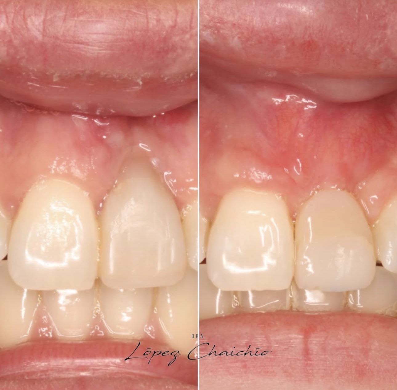 Problema mucogingival tras el fracaso de un implante inmediato en el 21: CAF con preservación papilar e injerto de tejido conectivo