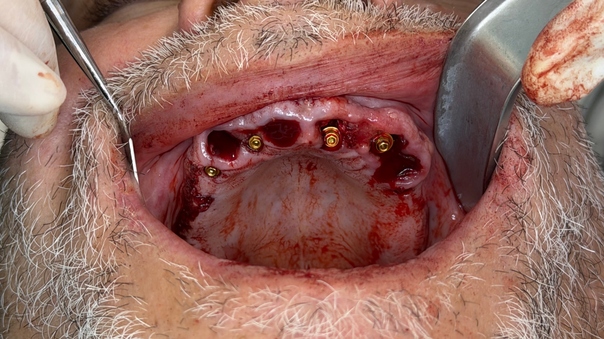 Cirugía guiada bimaxilar de 12 implantes con carga inmediata en periodontitis avanzada