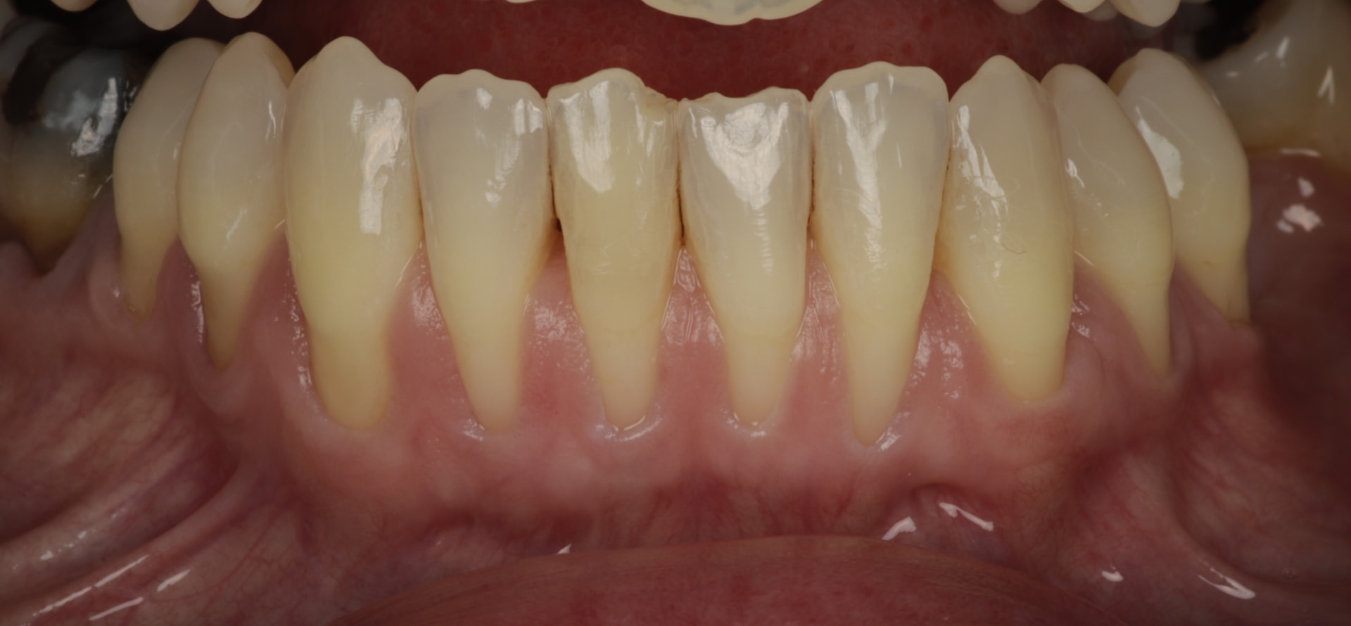 Cambio de fenotipo gingival con técnica ITC en recesiones mandibulares progresivas