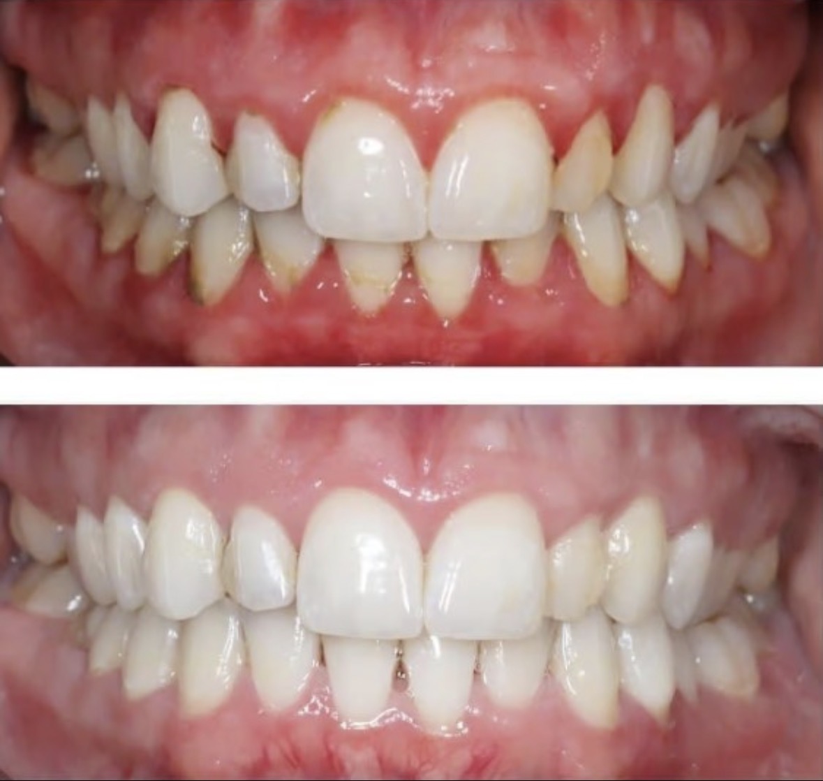 Gingivitis inducida por biofilm: aceite de coco como coadyuvante, no como sustituto
