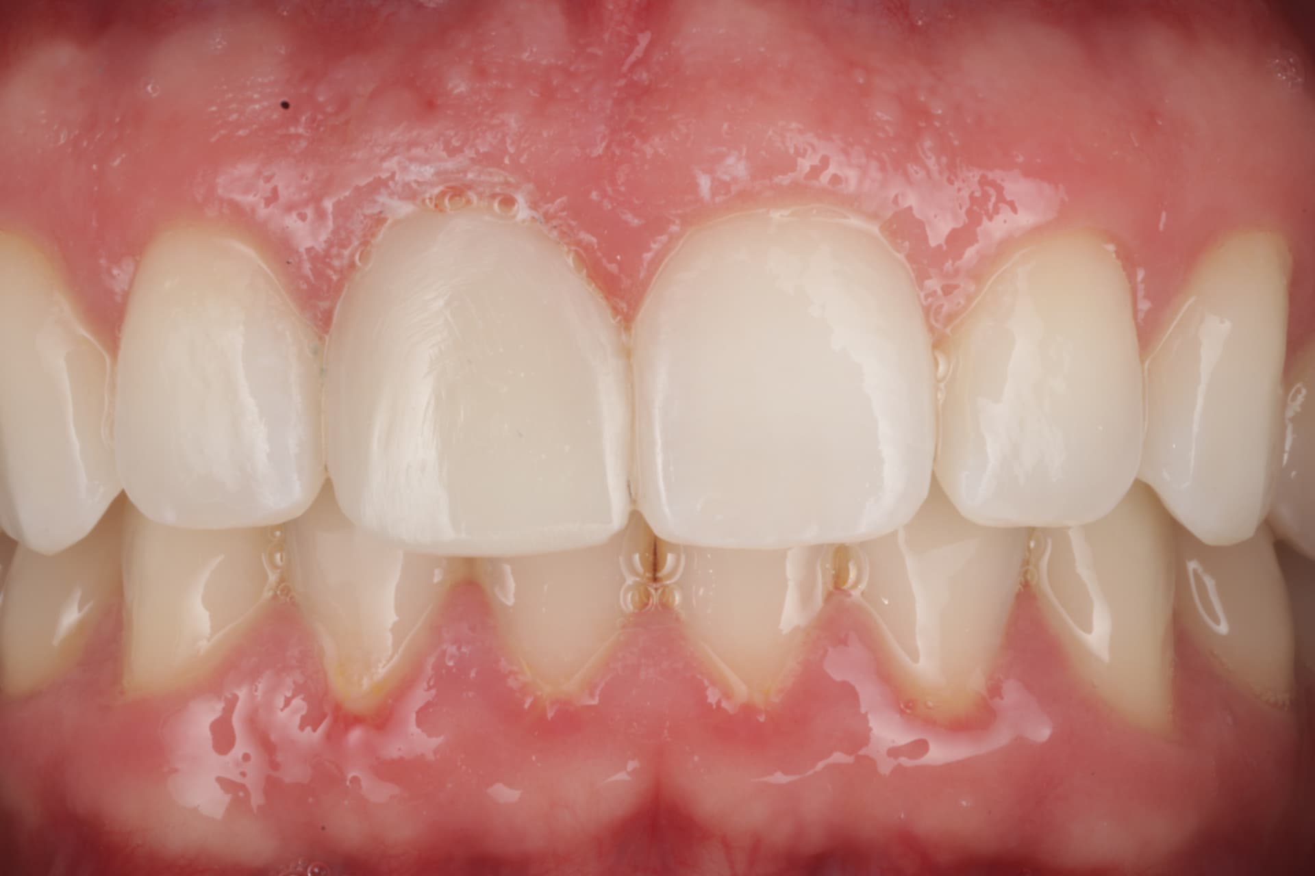 Blanqueamiento interno post endodoncia y sustitución de carilla de composite