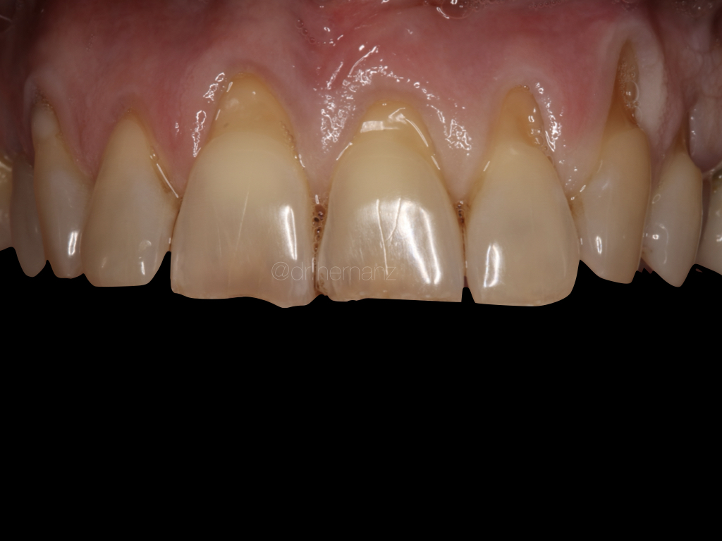 Recesiones múltiples de 1.4 a 2.4: túnel e injerto de tejido conectivo con sutura Sling-M