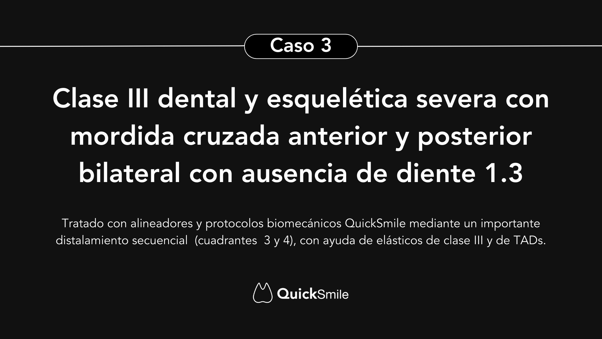 Clase III dental y esquelética severa con mordida cruzada anterior y posterior bilateral: distalamiento secuencial inferior con alineadores