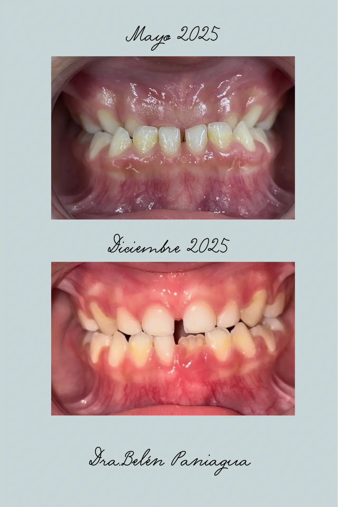 Rehabilitación masticatoria y respiratoria en paciente de 5 años