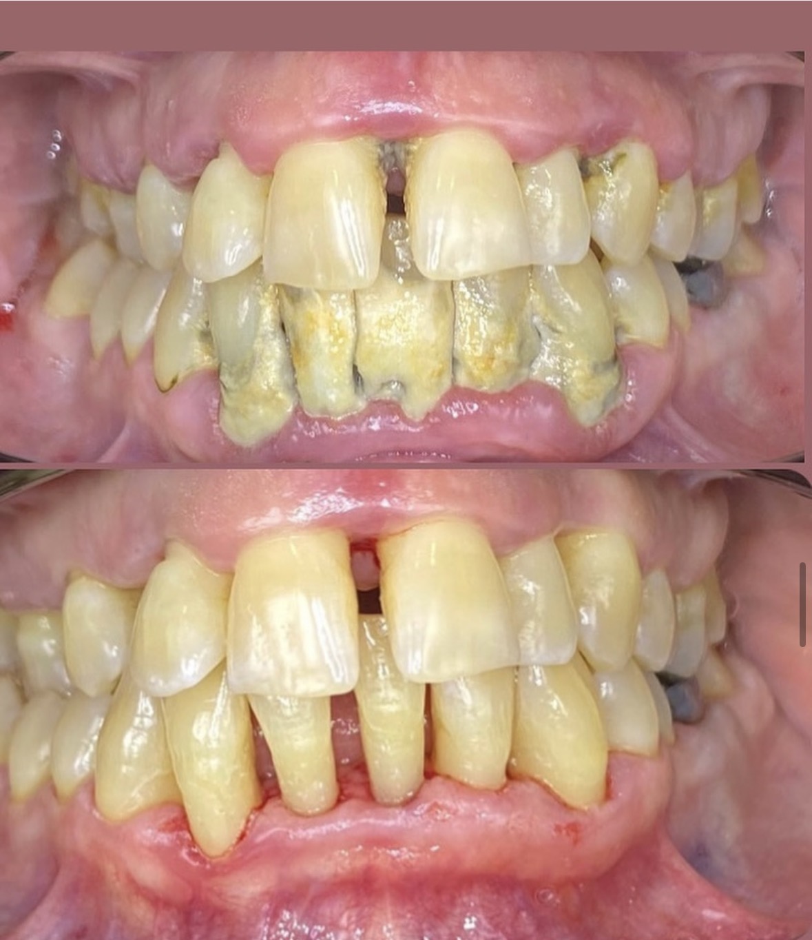 Tratamiento periodontal no quirúrgico en paciente fumadora con periodontitis avanzada