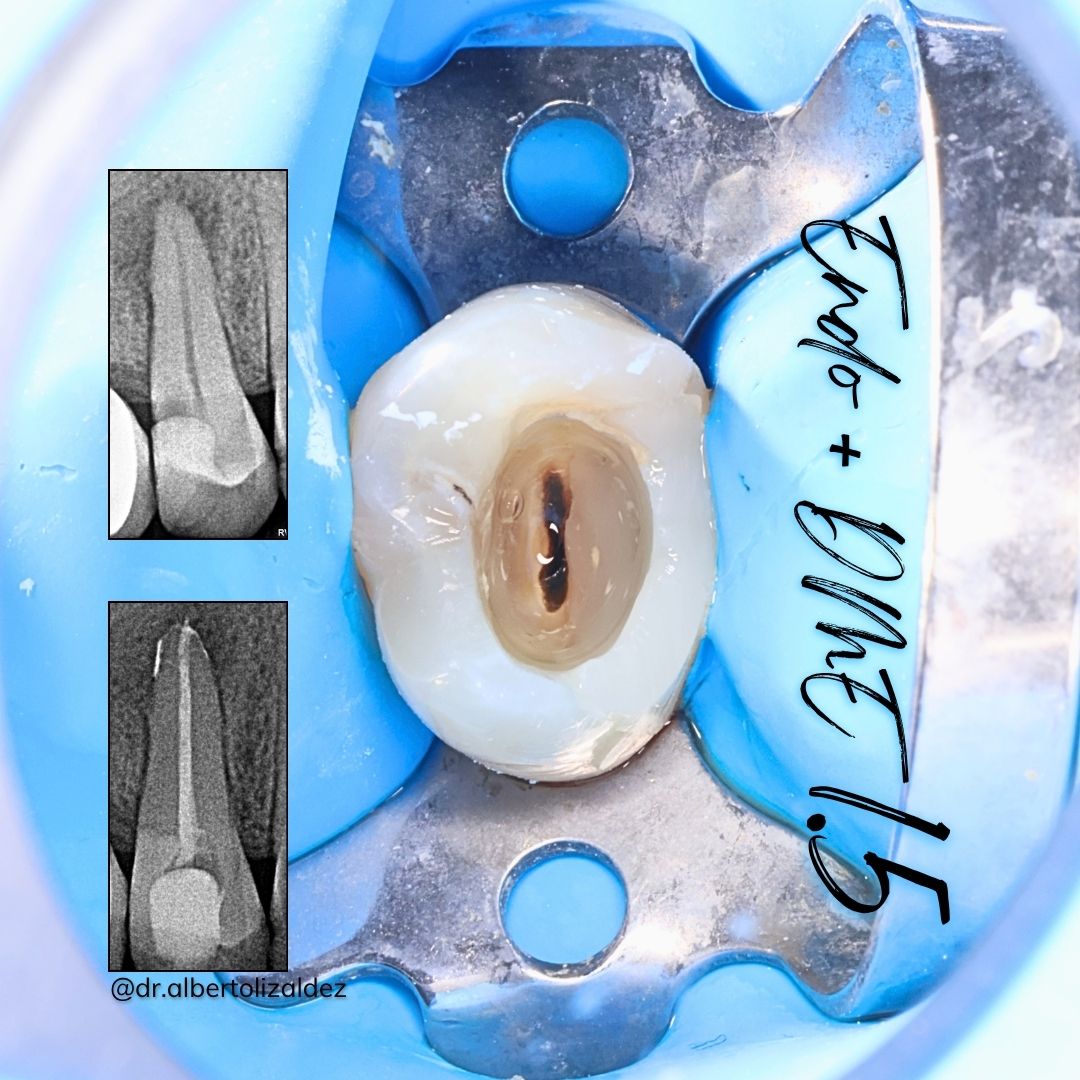 Retratamiento y reconstrucción del 1.5 con lesión periapical sintomática