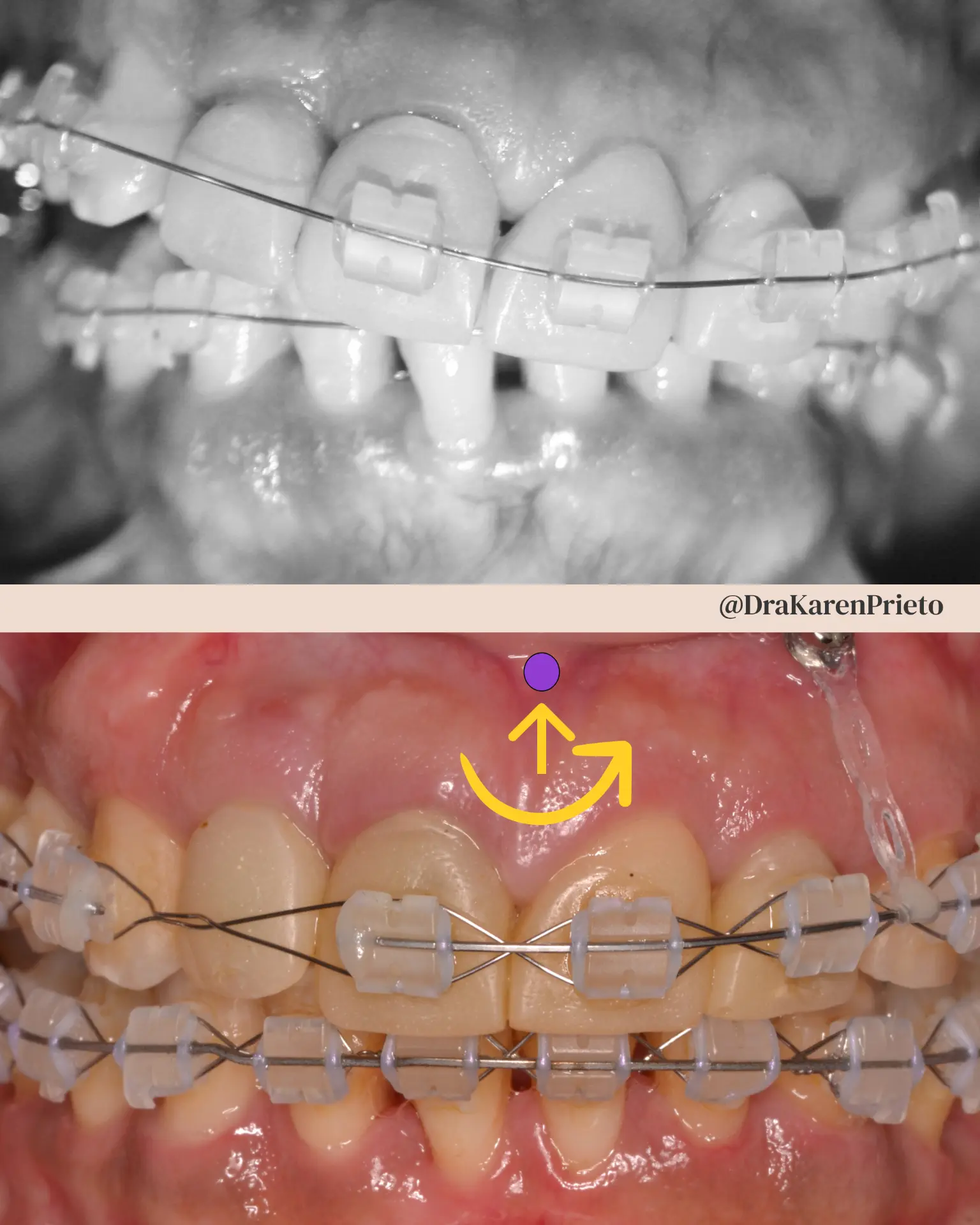 Nivelación del plano oclusal superior mediante rotación antihoraria