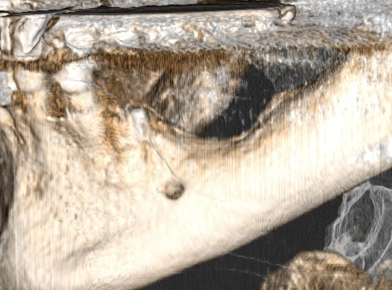 Reconstrucción tridimensional de un reborde mandibular atrófico mediante láminas corticales autólogas
