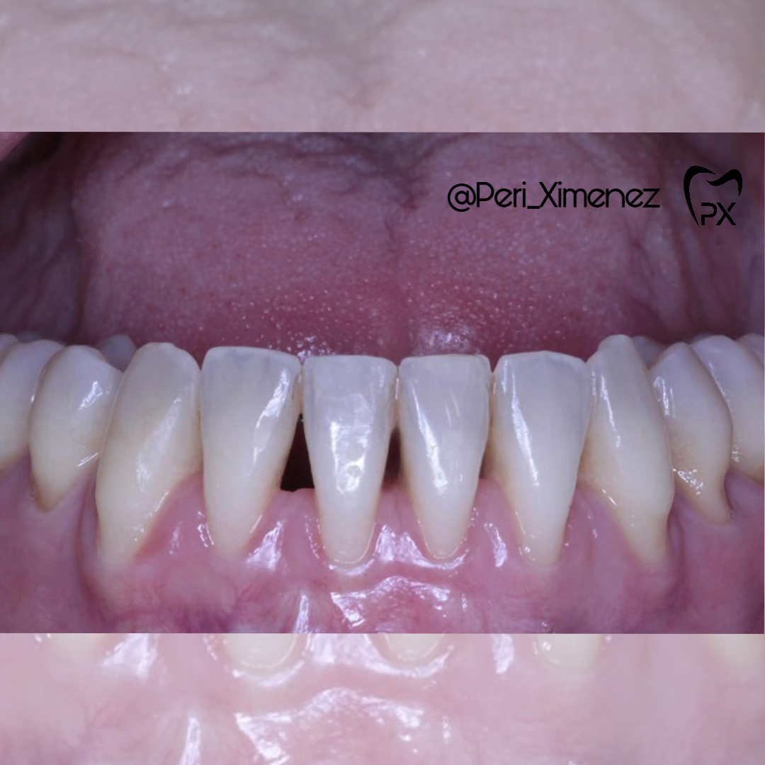 Recesiones gingivales vestibulares de 34 a 44